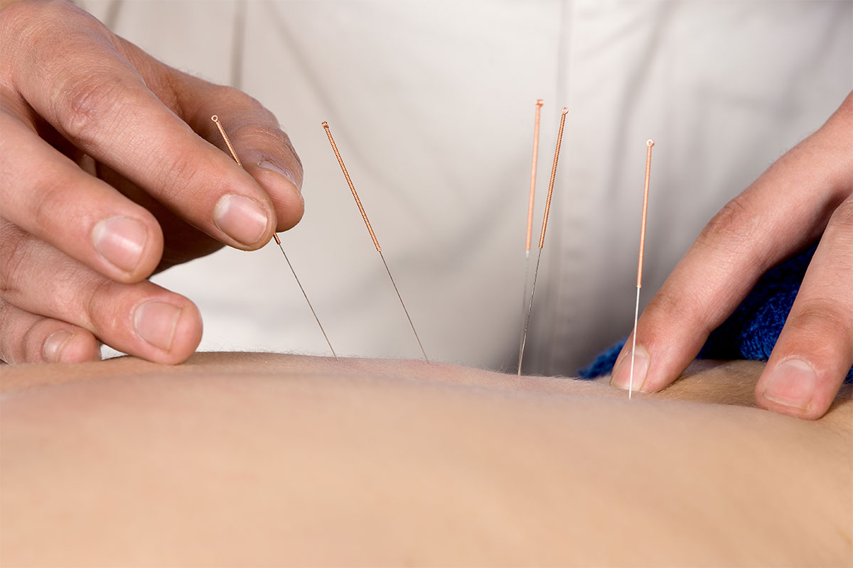 acupuncture needles going in skin