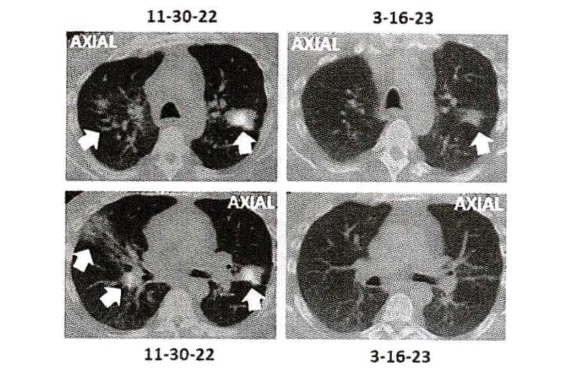 lung cancer screenings