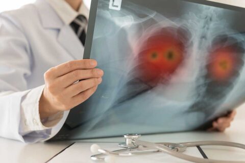 lung cancer xray